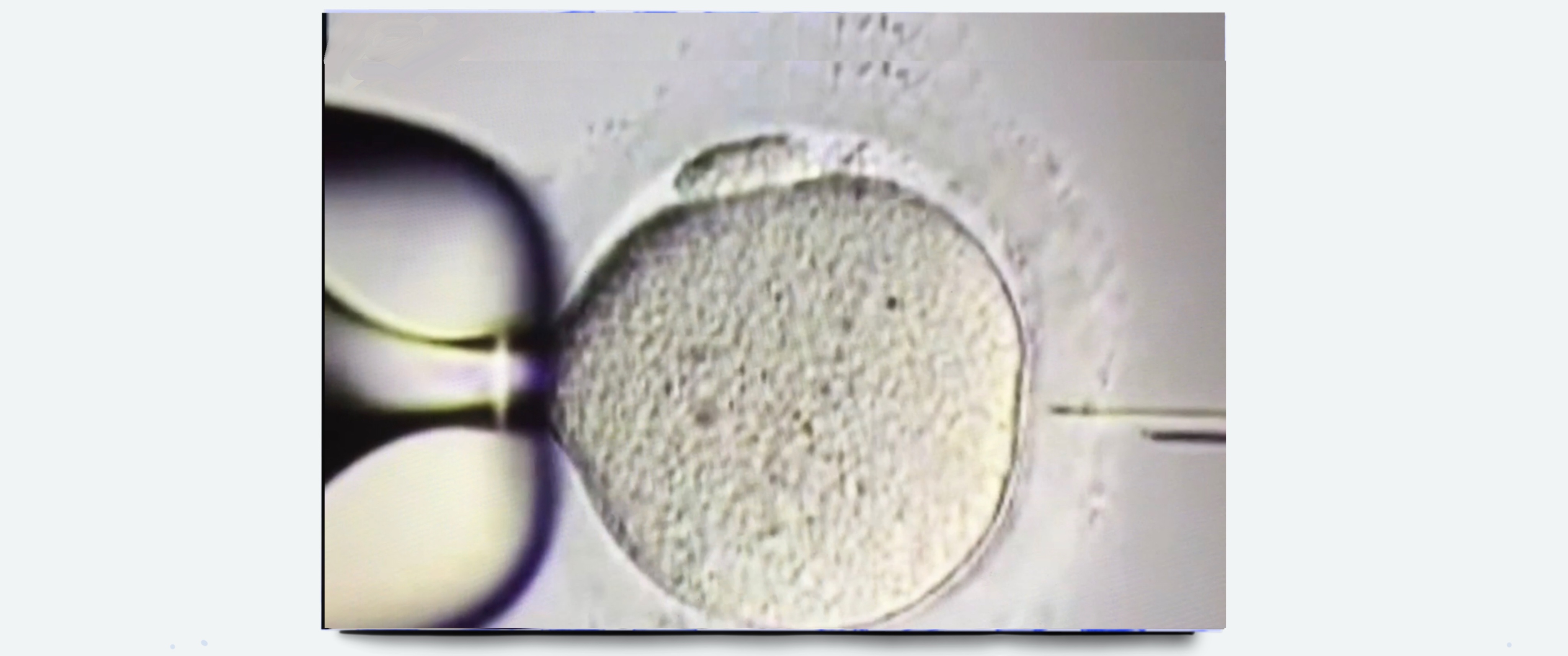 TÜP BEBEK “ICSI” NEDİR? İVF, ICSI Tüp Bebek Tedavisi